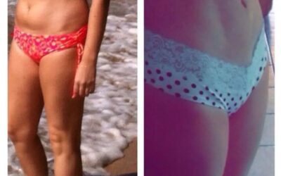 Excelentes resultados Slim Láser