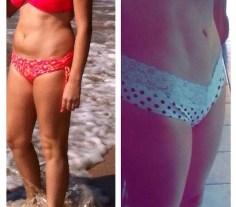 Excelentes resultados Slim Láser