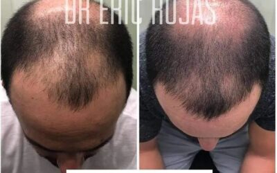 Recupere su cabello