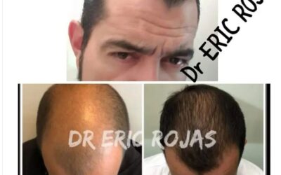 Tratamiento para la caída de cabello