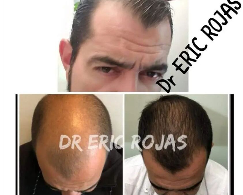 Tratamiento para la caída de cabello