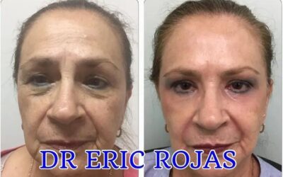 Rejuvenecimiento facial sin cirugía