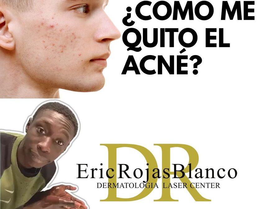 Sin ninguna pena para salir de casa, somos el centro especializado contra el acné mas preparado en Costa Rica.