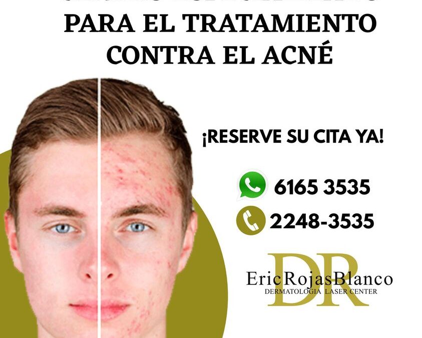 Sin ninguna pena para salir de casa, somos el centro especializado contra el acné mas preparado en Costa Rica.