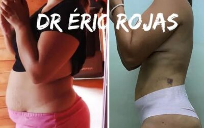 Resultados Slim Láser