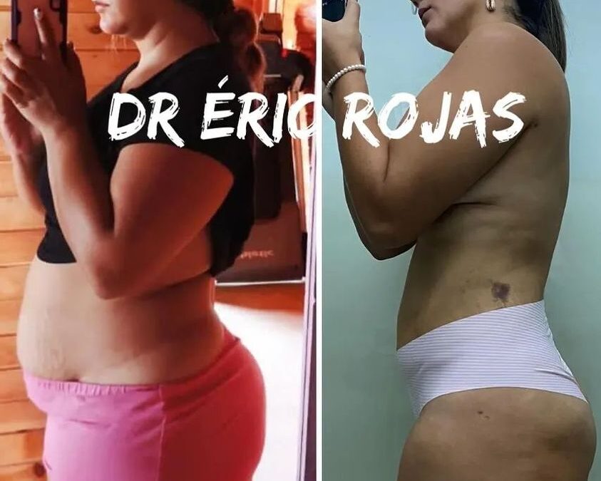 Resultados Slim Láser