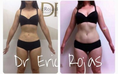 Abdomen Slim Láser