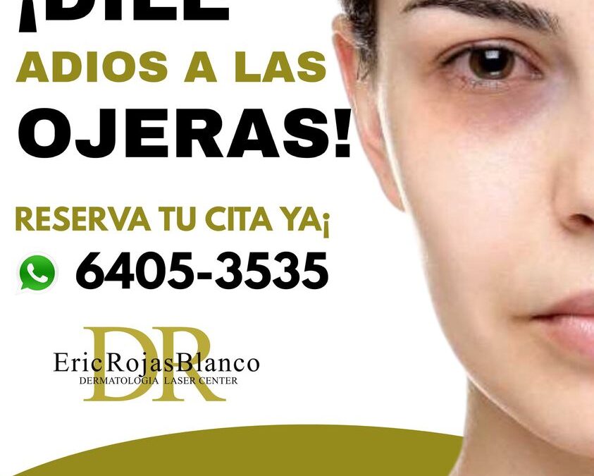 Eliminar sus ojeras y lucir una mirada fresca es posible
