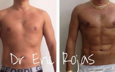 Abdomen Slim Láser