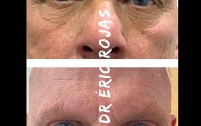 REFRESCA TU MIRADA DERMOBLEFAROPLASTIA LÁSER