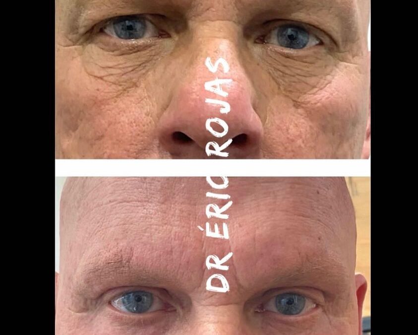 REFRESCA TU MIRADA DERMOBLEFAROPLASTIA LÁSER