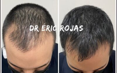 NO MÁS CAÍDA DE CABELLO