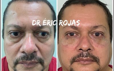 OJERAS