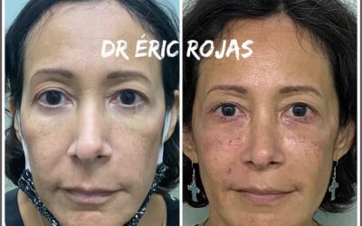 REFRESCAMIENTO FACIAL DR ÉRIC ROJAS 22483535