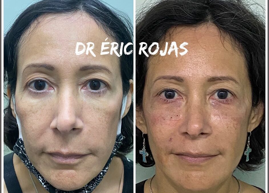 REFRESCAMIENTO FACIAL DR ÉRIC ROJAS 22483535