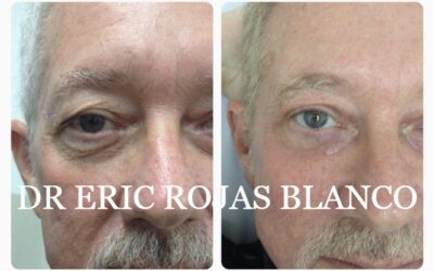 Eliminar sus ojeras y lucir una mirada fresca es posible