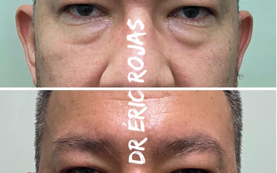 OJERAS CORRECCIÓN SIN CIRUGÍA DR ÉRIC ROJAS 22483535 en menos de 10 minutos