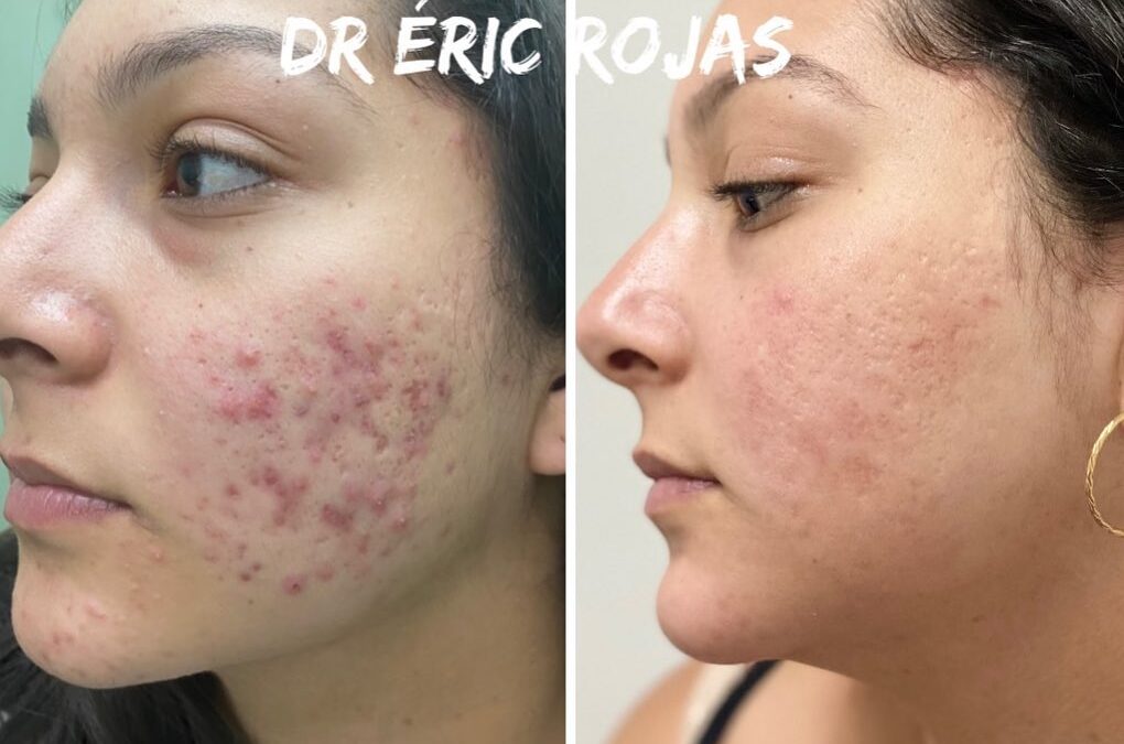 ACNÉ YA NO MÁS DR ÉRIC ROJAS