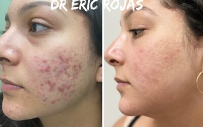 ACNÉ YA NO MÁS DR ÉRIC ROJAS