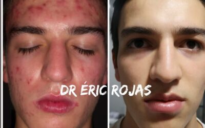 ACNE DR ÉRIC ROJAS 22483535 búscanos