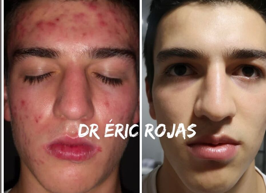 ACNE DR ÉRIC ROJAS 22483535 búscanos