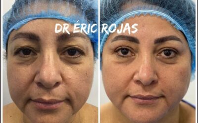 REFRESCAMIENTO FACIAL DR ÉRIC ROJAS 22483535
