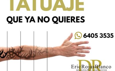 ¿ Quieres Eliminar tu Tatuaje ?