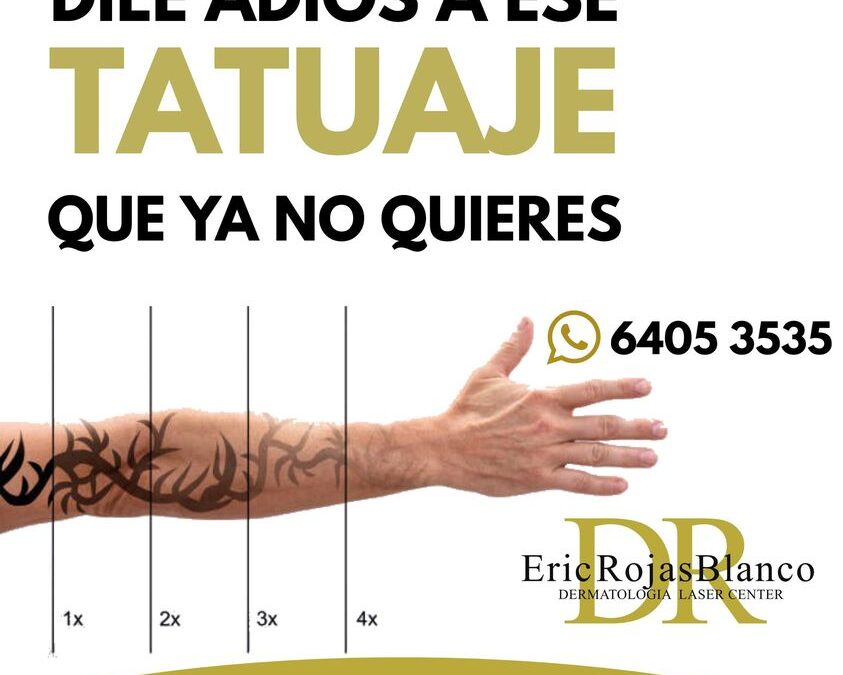 ¿ Quieres Eliminar tu Tatuaje ?