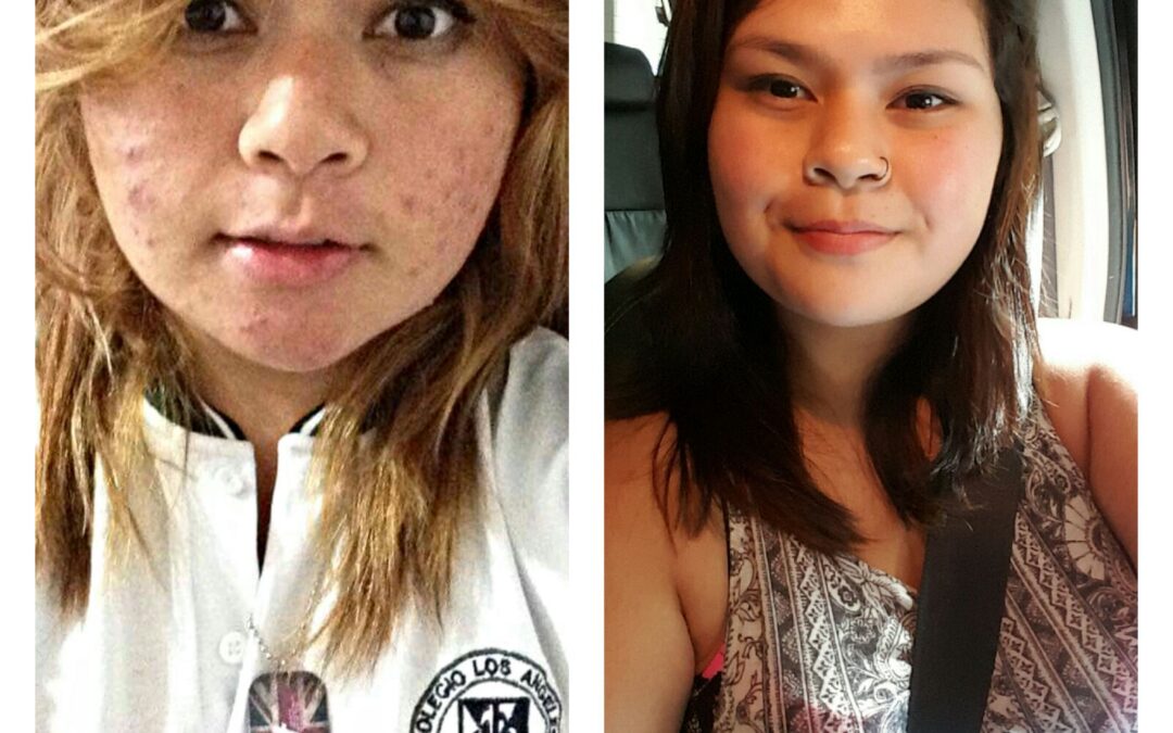 SOMOS EL NUMERO UNO, en el tratamiento contra el acné!!!!!