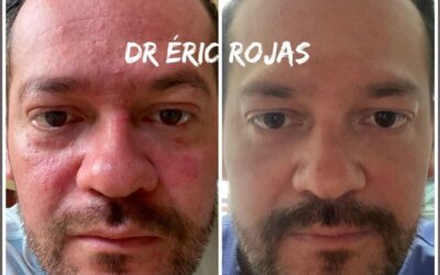 ROSÁCEA YA NO DEBES SUFRIR MÁS DR ÉRIC ROJAS TE MEJORA TU ROSTRO 22483535