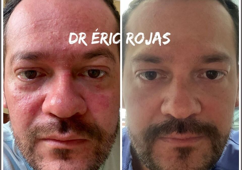 ROSÁCEA YA NO DEBES SUFRIR MÁS DR ÉRIC ROJAS TE MEJORA TU ROSTRO 22483535