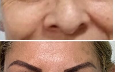 REFRESCAMIENTO FACIAL CON TRATAMIENTO DE PARPADOS DR ÉRIC ROJAS 22483535