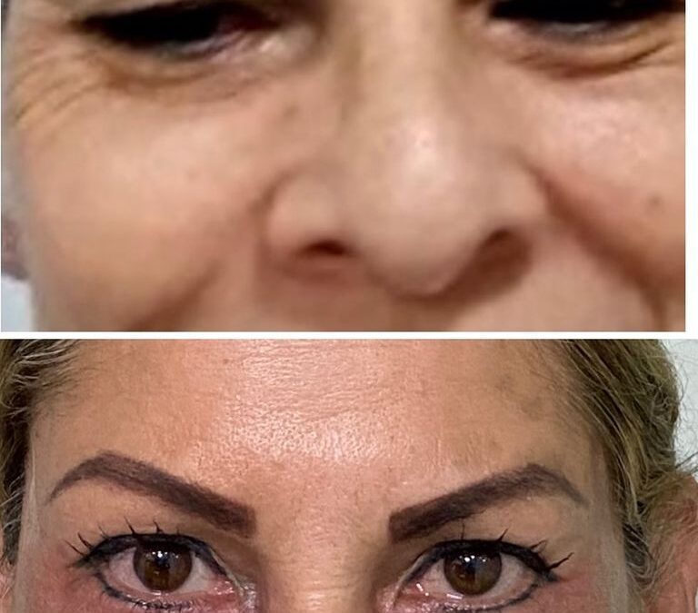 REFRESCAMIENTO FACIAL CON TRATAMIENTO DE PARPADOS DR ÉRIC ROJAS 22483535