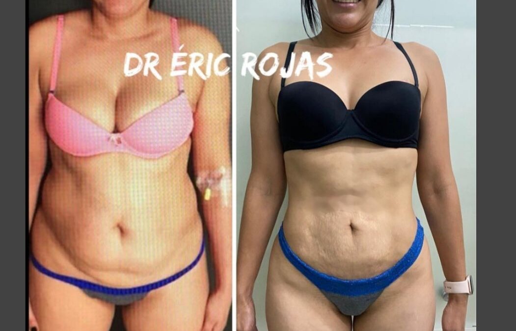 SLIM LÁSER DR ÉRIC ROJAS CAMBIA TU CUERPO CAMBIA TU VIDA