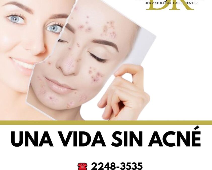 Sin ninguna pena para salir de casa, somos el centro especializado contra el acné mas preparado en Costa Rica.