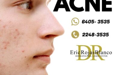 El acné es un trastorno de la piel