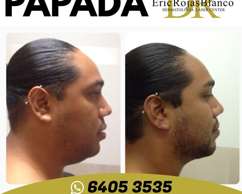 Eliminación de papada