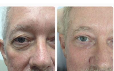 Eliminar sus ojeras y lucir una mirada fresca es posible