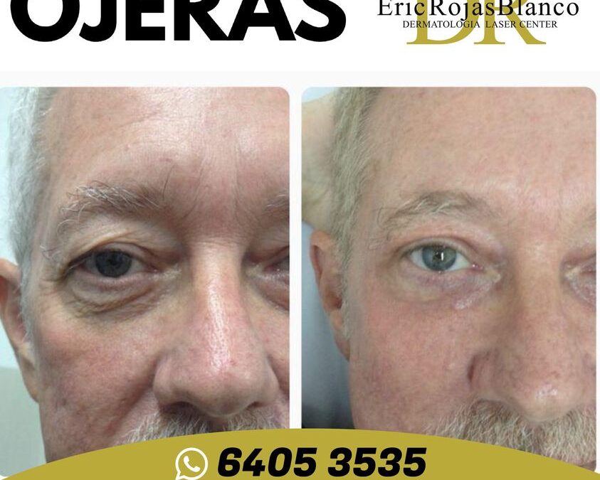 Eliminar sus ojeras y lucir una mirada fresca es posible