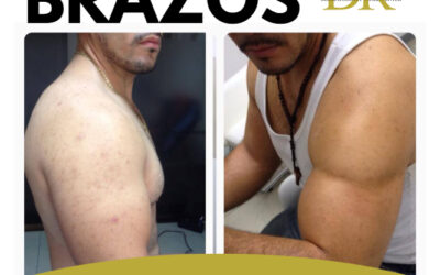 MARCACION DE BRAZOS