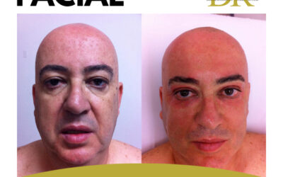 REJUVENECIMIENTO FACIAL