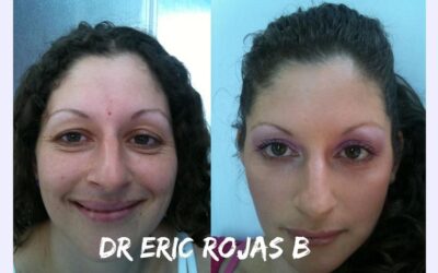 REJUVENECIMIENTO FACIAL