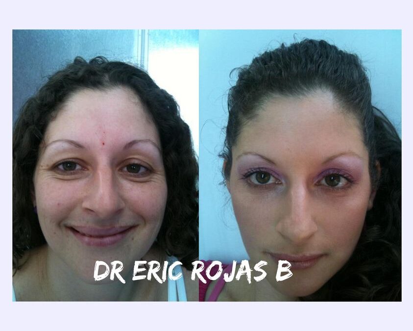 REJUVENECIMIENTO FACIAL