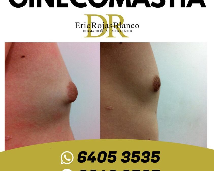 Ginecomastía