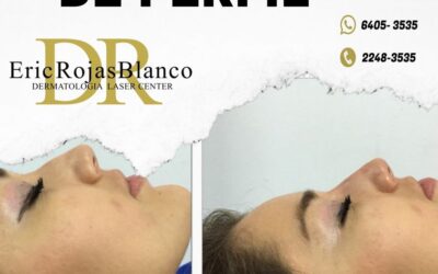 Tú también puedes mejorar el perfil de tu nariz