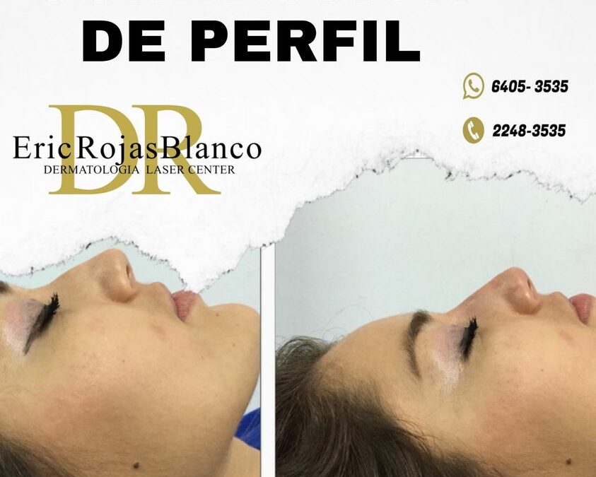 Tú también puedes mejorar el perfil de tu nariz