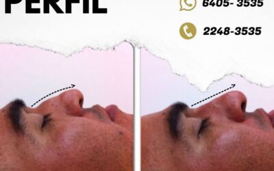 Tú también puedes mejorar el perfil de tu nariz.