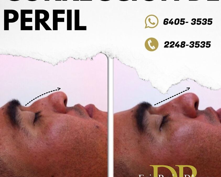 Tú también puedes mejorar el perfil de tu nariz.