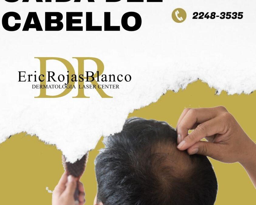 La caída del cabello es uno de los principales motivos de consulta dermatológica.