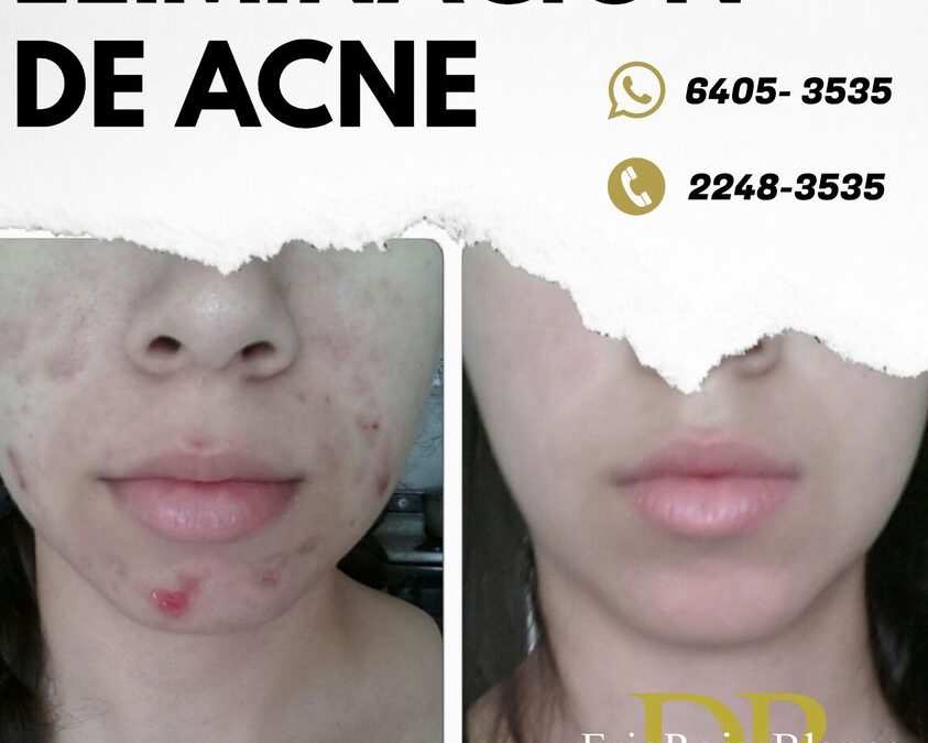 Somos el centro especializado en la eliminación de acné
